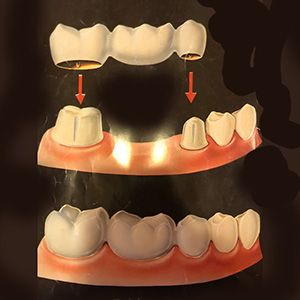 Dental Crowns and Bridges
