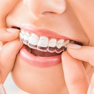 Invisalign Aligners
